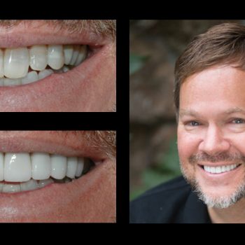 Bret Saunders, KBCO veneers before and after dental photo gallery from Incredible Smiles in Boulder, CO