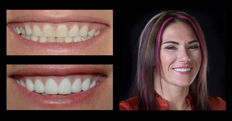 before-after incredible smiles dental photo gallery lynn_cat Z