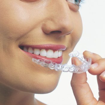 Invisalign invisible braces are the go-to choice for millions of adults in America but there are lots of other options on the market too.