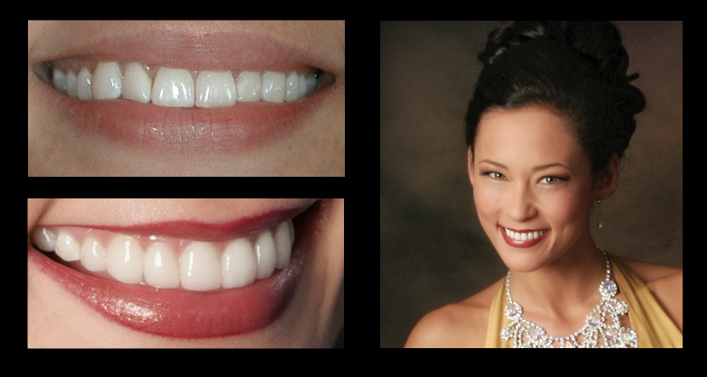 before and after Dental Photo Gallery: Jennifer at Incredible Smiles
