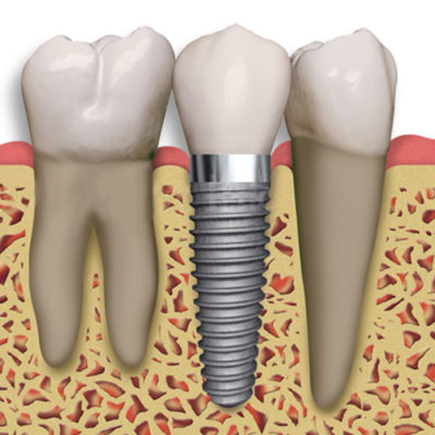 Dental implants are the new standard of care for missing teeth. Consider an implant at Incredible Smiles for a missing tooth.