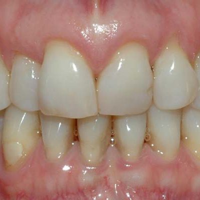 gum recession and exposed root structure put teeth at risk for sensitivity, infection and loss.