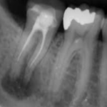 root canal can be root cause of illness