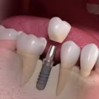 Missing Tooth Here Are Your Options Blog Incredible Smiles
