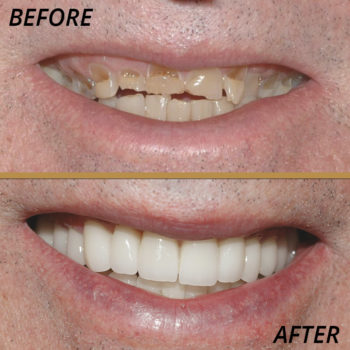 healthy smiles before and after