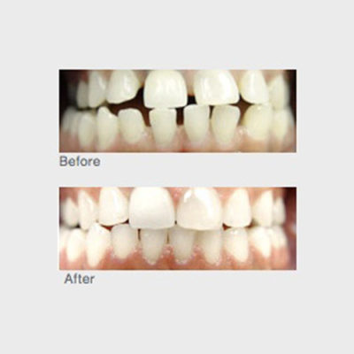 Are You Ready for a Smile Makeover? has different issues with their teeth and smile so treatment is unique to the individual. Some need to research the pros and cons of veneers, others just need a simple whitening and some will require braces – the path to a perfect smile is different for everyone.