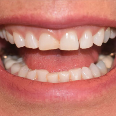 The question about temporary veneers comes up during the cosmetic consultation. The temporaries are critical to the entire process.