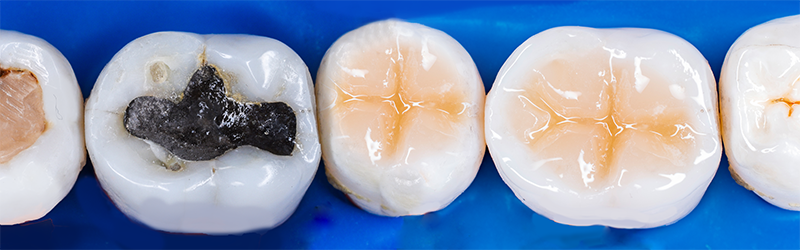 Mercury fillings are toxic to our health. Learn the basics about the cost of mercury filling removal and the steps involved in the procedure.