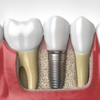 Dental Implants Boulder