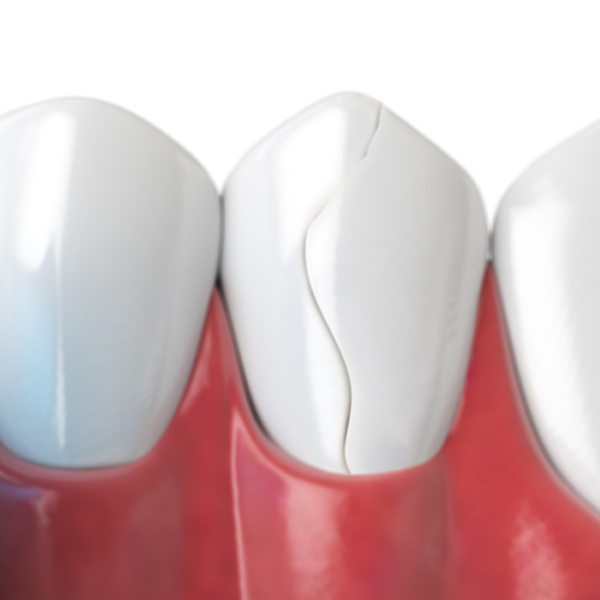 Cosmetic dentistry for damaged teeth