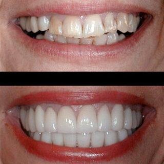 Boulder dental veneers before and after