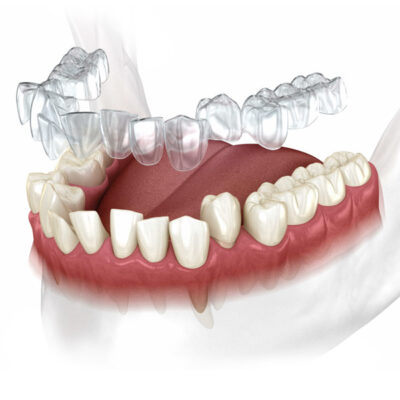 Clear aligners at Incredible Smiles