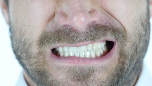 hidden dangers of bruxism or teeth grinding
