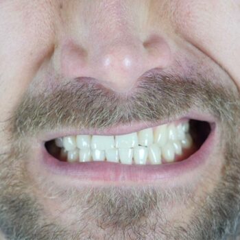 teeth grinding and oral health