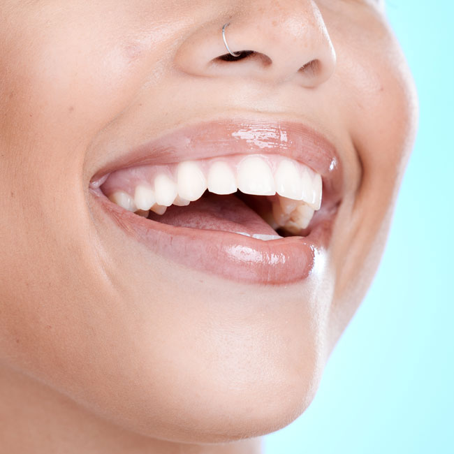 Professional teeth whitening at Incredible Smiles