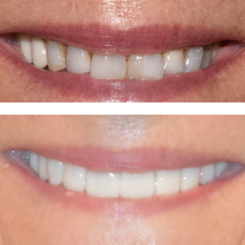 Dental veneers vs. Dental Bonding