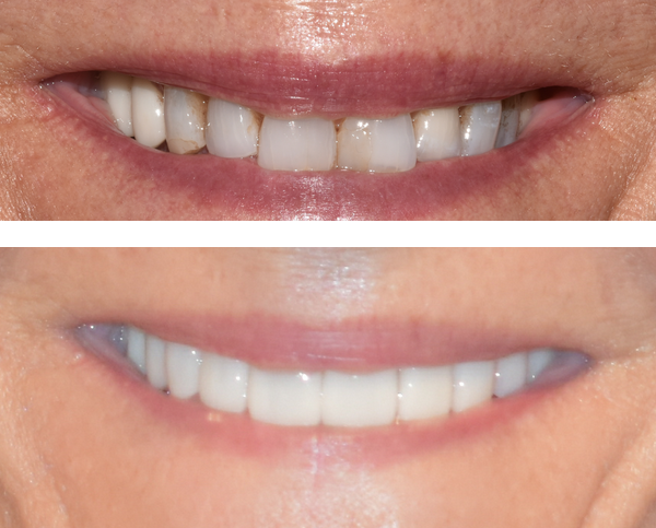 Dental veneers vs. Dental Bonding