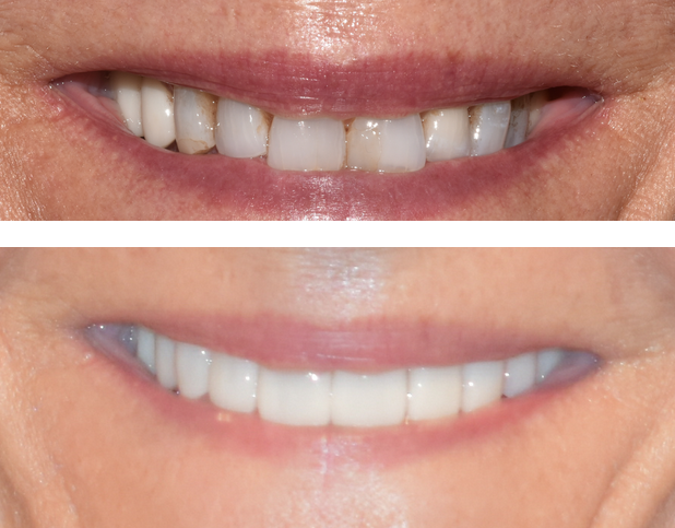 Dental veneers vs. Dental Bonding