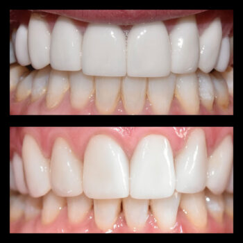 natural looking veneers