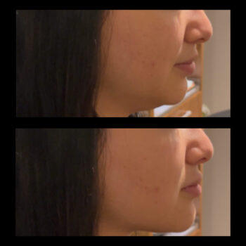 Mewing - tongue posture & facial aesthetics