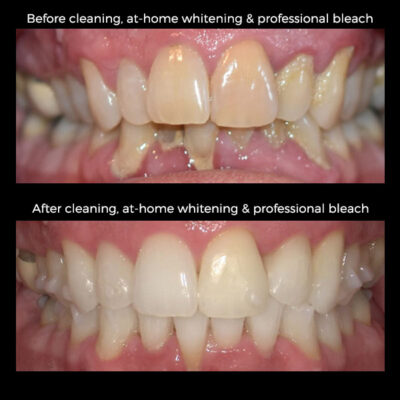 Teeth whitening myths